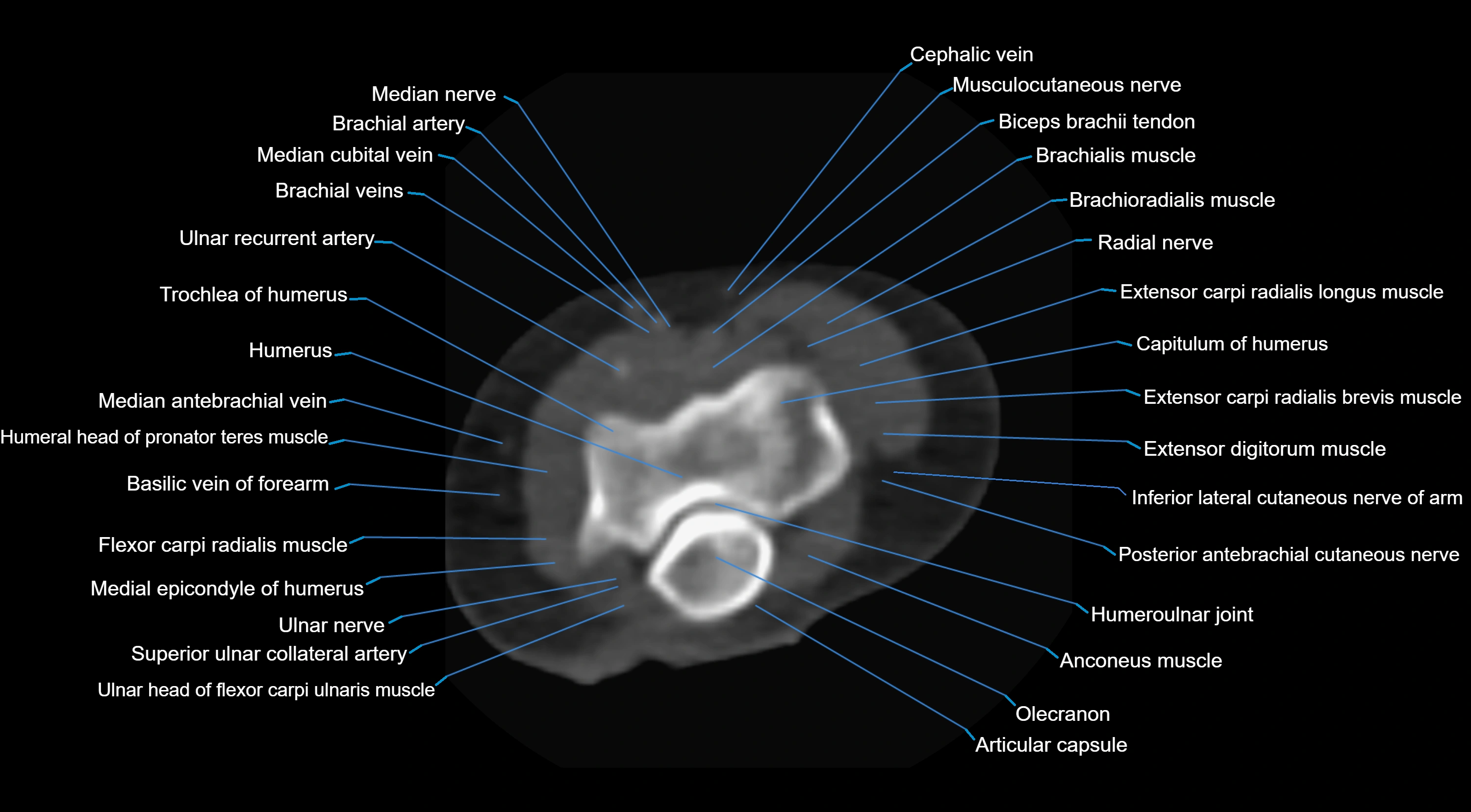 CT elbow axial  cross sectional anatomy labelled  radiology image -00023.webp